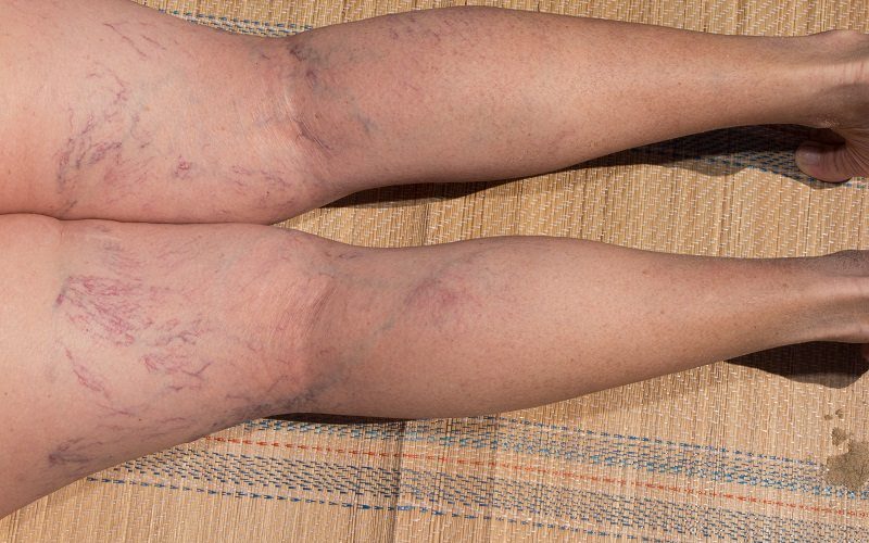 What are Varicose Veins and Spider Veins?